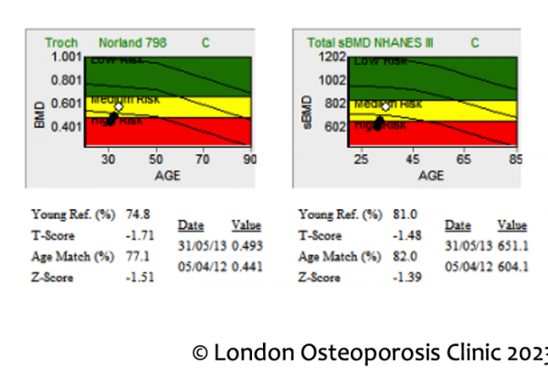 Bone Mineral Density (BMD) assessment graphs showing T-score and fracture risk levels