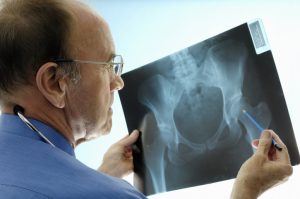 The Osteoporosis Burden: Confronting Hip Fractures