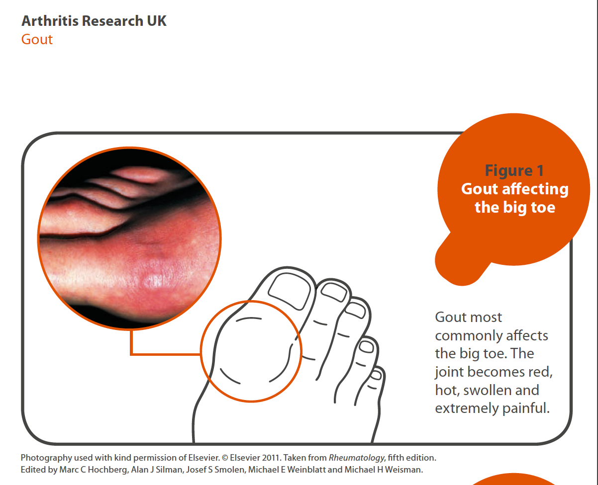 London Osteoporosis Clinic: Advice on the Treatment of Suspected Acute Gout