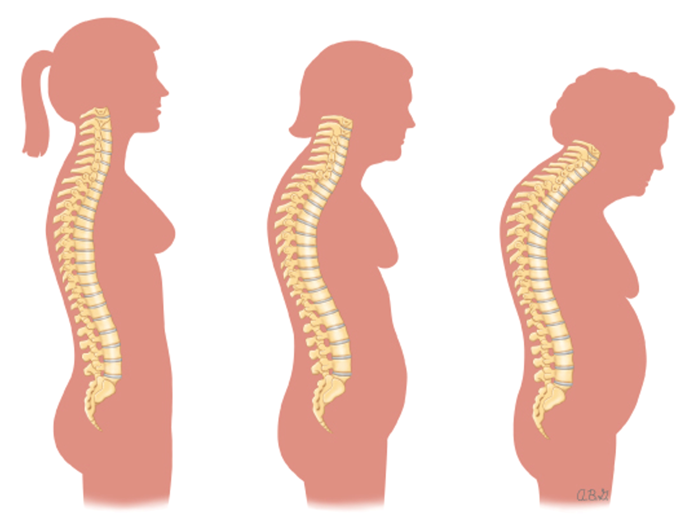 Celebrating World Spine Day: Unveiling the Connection Between Osteoporosis and Spinal Health