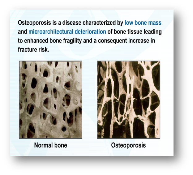 An image comparing normal bone and a bone with osteoporosis
