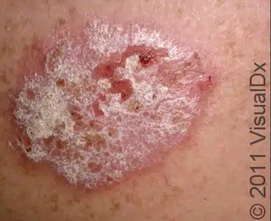 Psoriasis Lifestyle Management Tips: Essential Strategies for Skin Health (Part 1)