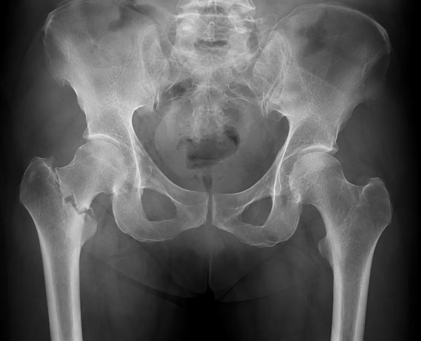 Hip fracture X-ray — common consequence of untreated osteoporosis in men